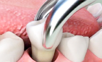 Soul Family DentalTooth Extractions service