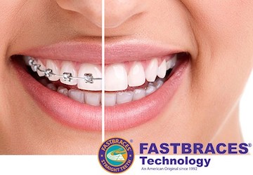 Soul Family DentalFast Braces service