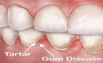 Soul Family DentalPeriodontal (Gum) Disease service