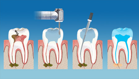 Soul Family DentalEndodontics Therapy service