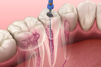 Soul Family DentalRoot Canal Therapy service